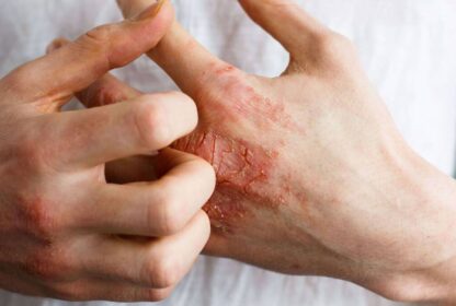 Psoriasis, Eczéma et Allergies Cutanées
