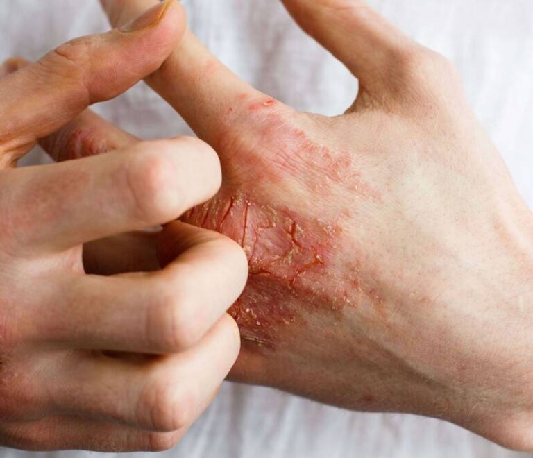 Psoriasis, Eczéma et Allergies Cutanées