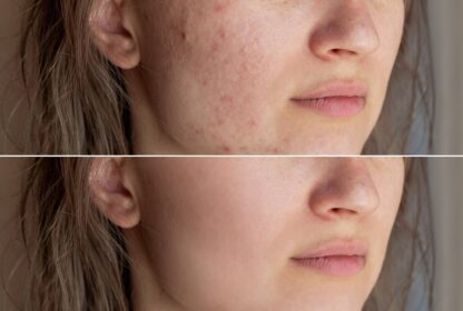 Dermatologue Acné Cicatrices Fès