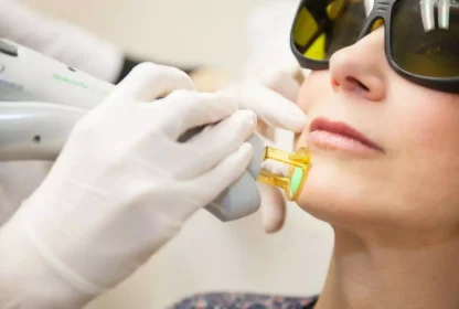 épilation laser visage Fès
