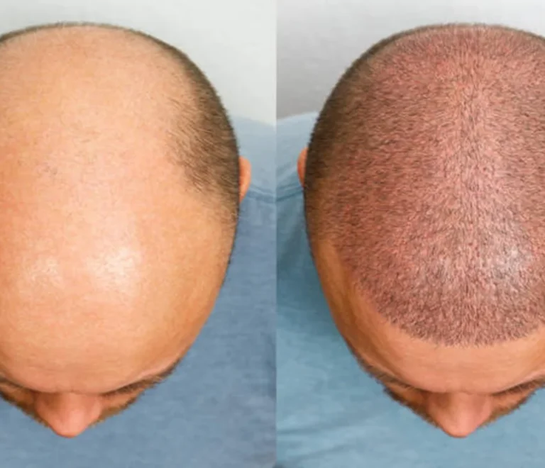 Greffe de Cheveux FUE DHI Fès